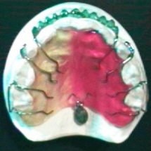 Gaumenplatte mit Pendel und Rillen