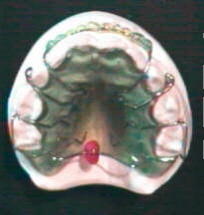 Gaumenplatte mit Perle und Rillen