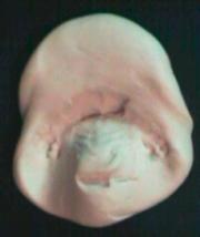 Abformung des Oberkiefers